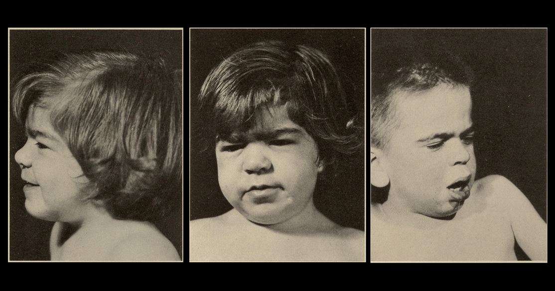 FDA Approves First-Ever Treatment for Sanfilippo Syndrome, Bringing New Hope to Children With a Fatal Rare Disease